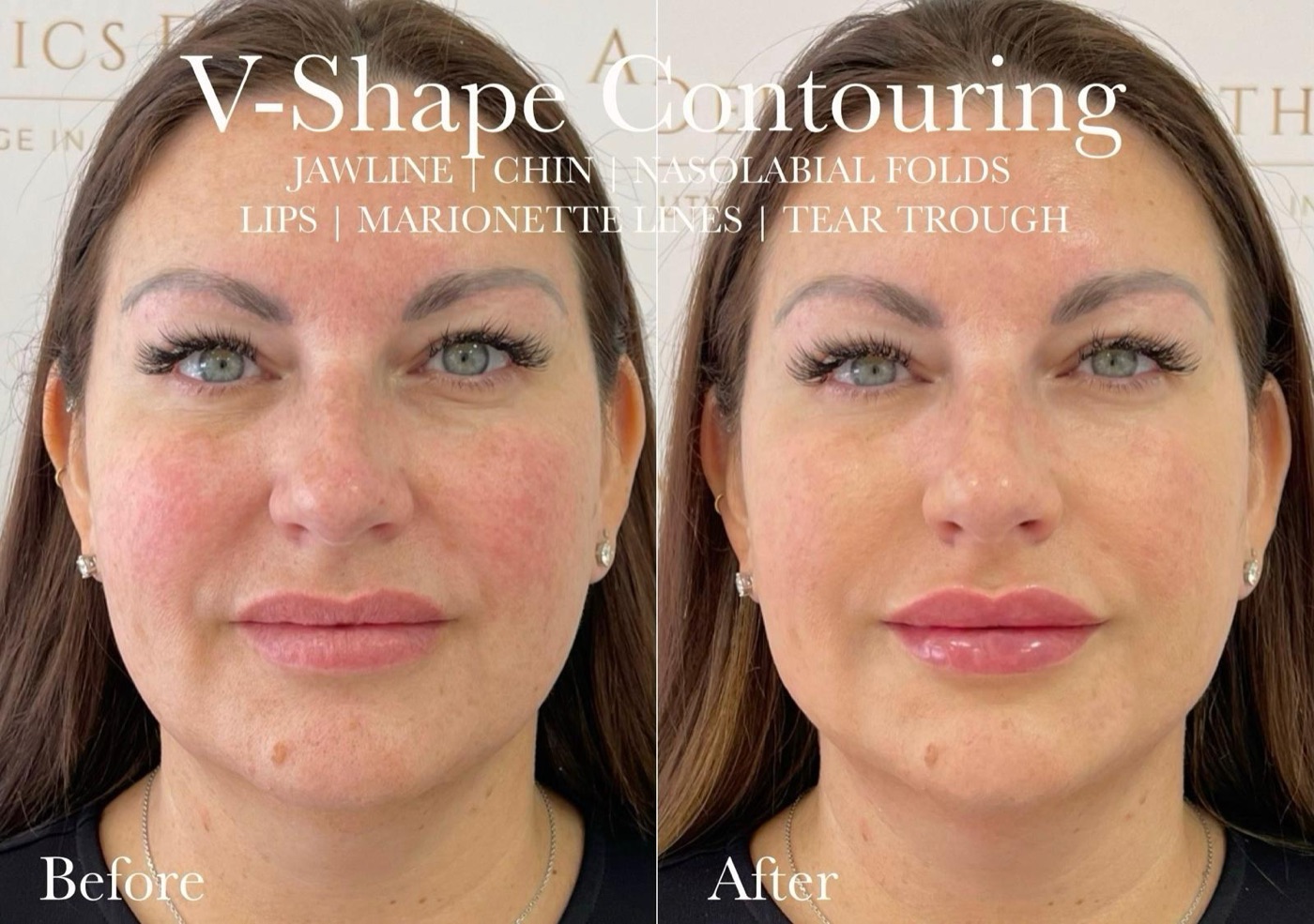 Before and after: jawline, chin, nasolabial folds, lips, marionette lines and tear trough