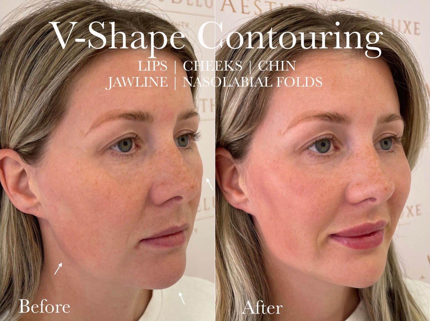 Before and after: lips, cheeks, chin, jawline and nasolabial folds